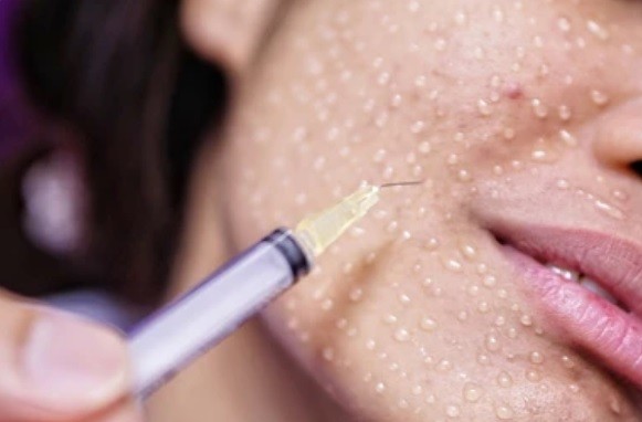 Dermabrasion Treatment