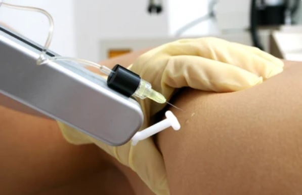 Dermabrasion Treatment